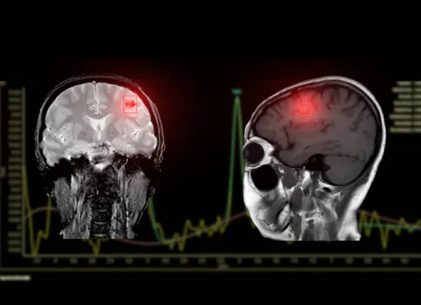 Felç Hastalıklarında Spektroskopisi Yardımcı Olur Etkilenen Beyin Dokularındaki Metabolik Değişiklikleri Stok Resim