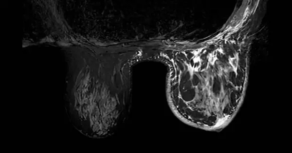 Breast Mri Revealing Rads Women Indicates Suspicious Findings Warranting Further Royalty Free Stock Photos