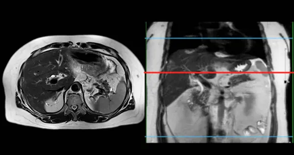 Mri Upper Abdomen Non Invasive Imaging Technique Providing Detailed Visuals Stock Photo