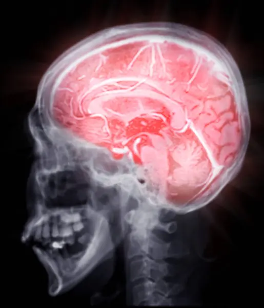 Мрт Мозга Сканирования Сагиттальной Плоскости Обнаружения Суши Болезни Мозга Инсульта Лицензионные Стоковые Изображения