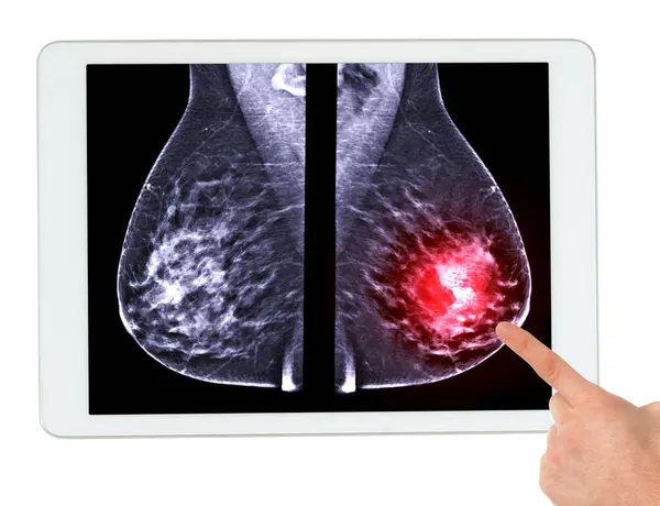 Tablet Mammografi Meme Taramasında Meme Kanserinin Sol Göğüste Lezyon Olup Stok Fotoğraf