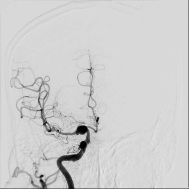 Beyin anjiyografisi, beyindeki atardamar ve damarları tıbbi teşhis için görselleştirmek için özel bir prosedürdür..