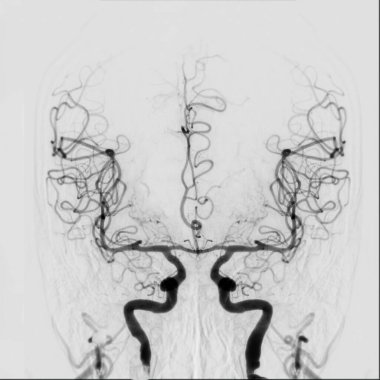 Cerebral angiography is a specialized procedure to visualize the arteries and veins in the brain for medical diagnosis. clipart