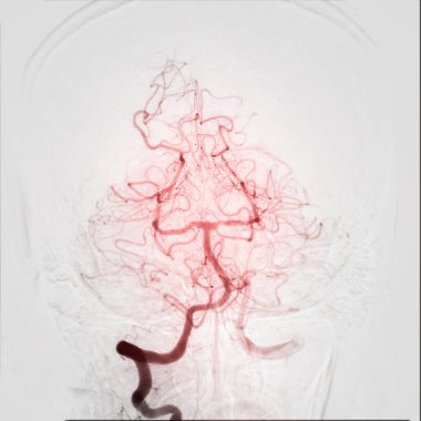 Cerebral angiography is a specialized procedure to visualize the arteries and veins in the brain for medical diagnosis. clipart