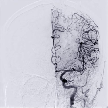 Cerebral angiography is a specialized procedure to visualize the arteries and veins in the brain for medical diagnosis. clipart