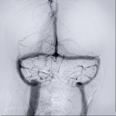The cerebral angiogram provides detailed images of the brain's venous system, aiding in diagnosis. clipart