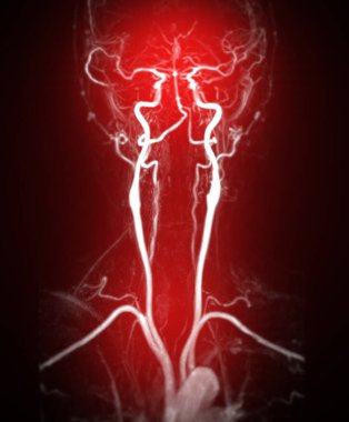 MRA Brain and neck or Magnetic resonance angiography ( MRA )  of cerebral artery and common carotid artery  for evaluate them  stenosis  and stroke disease. clipart