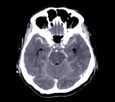 Tomografide subaraknoid kanama olduğu görülüyor..