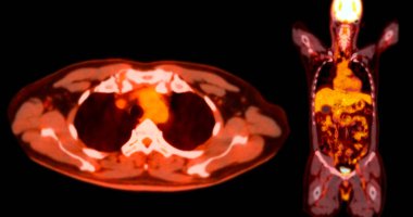 PET tomografi görüntüsü organların ve dokuların kapsamlı görüntülerini gösteriyor.