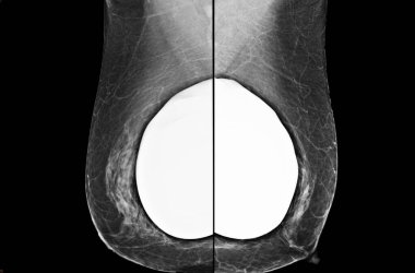 The mammogram BI-RADS 2-benign shows a breast implant augmentation with visible signs of capsular contracture. clipart