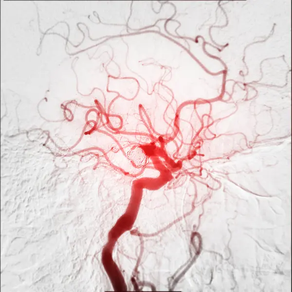 stock image Endovascular coiling during a cerebral angiogram shows the precision required for treating vascular conditions.