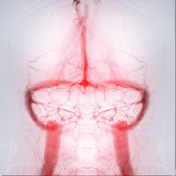 Stock image The cerebral angiogram provides detailed images of the brain's venous system, aiding in diagnosis.