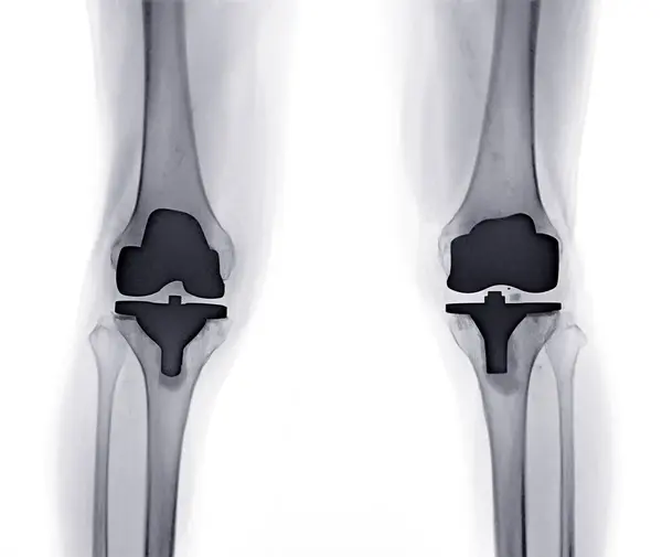 stock image X-ray image of knee joint AP  view reveals Knee Replacement.