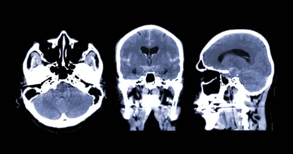 stock image A CT brain scan reveals a subarachnoid hemorrhage with clear signs of bleeding.