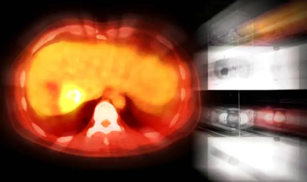 stock image A PET CT scan reveals cholangiocarcinoma with suspected metastatic involvement of the lungs and lymph nodes