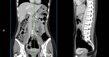 Kontrastlı CT 'nin tümünde normal anatomik yapılar görüldü. Patoloji veya anormal sıvı birikimi yok..