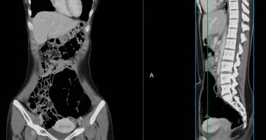 Contrast-enhanced CT whole abdomen study revealing normal anatomical structures, with no signs of pathology or abnormal fluid accumulation. clipart