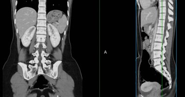 Kontrastlı CT 'nin tümünde normal anatomik yapılar görüldü. Patoloji veya anormal sıvı birikimi yok..