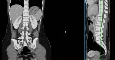 Contrast-enhanced CT whole abdomen study revealing normal anatomical structures, with no signs of pathology or abnormal fluid accumulation. clipart