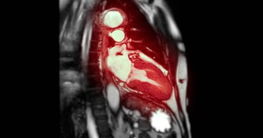 MRI kalp stres testi, kontrollü koşullar altında detaylı kalp fonksiyonlarını gösteriyor, erken teşhis ve yüksek çözünürlüklü görüntüleme stres sırasında kalp performansını yakalıyor.