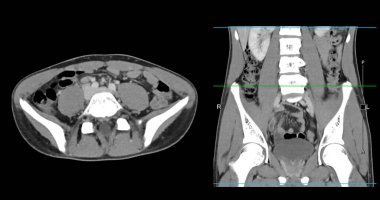  Yüksek çözünürlüklü CT taraması karın altı normal, tıbbi eğitim için mükemmel, teşhis referansı ve sağlık sunumları. Açık anatomik vurgu sağlıklı karın yapısını gösteriyor..