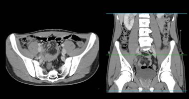 Yüksek çözünürlüklü CT taraması karın altı normal, tıbbi eğitim için mükemmel, teşhis referansı ve sağlık sunumları. Açık anatomik vurgu sağlıklı karın yapısını gösteriyor..