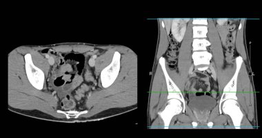  Yüksek çözünürlüklü CT taraması karın altı normal, tıbbi eğitim için mükemmel, teşhis referansı ve sağlık sunumları. Açık anatomik vurgu sağlıklı karın yapısını gösteriyor..