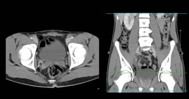  Yüksek çözünürlüklü CT taraması karın altı normal, tıbbi eğitim için mükemmel, teşhis referansı ve sağlık sunumları. Açık anatomik vurgu sağlıklı karın yapısını gösteriyor..