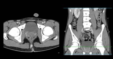  Yüksek çözünürlüklü CT taraması karın altı normal, tıbbi eğitim için mükemmel, teşhis referansı ve sağlık sunumları. Açık anatomik vurgu sağlıklı karın yapısını gösteriyor..
