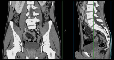  Yüksek çözünürlüklü CT taraması karın altı normal, tıbbi eğitim için mükemmel, teşhis referansı ve sağlık sunumları. Açık anatomik vurgu sağlıklı karın yapısını gösteriyor..