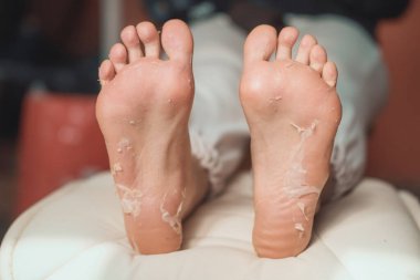 Güzellik kliniğinde kimyasal peeling tedavisinden sonra ayakların yakın çekimi.