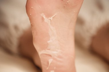 Kimyasal kabuktan sonra yumuşak ayaklar