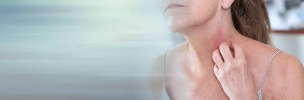 Een Vrouw Met Jeuk Krassen Haar Nek Allergie Symptomen Panoramische — Stockfoto