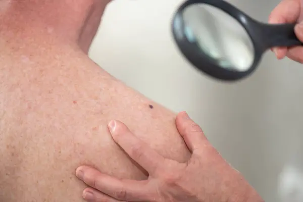 stock image Dermatologist examining skin of patient shoulder with magnifying glass