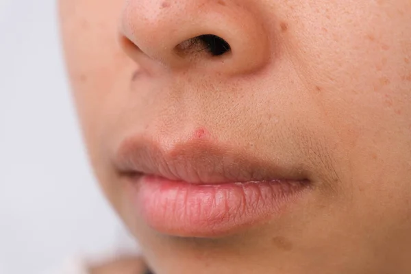Close-up of freckles on Asian woman\'s face. Middle-aged woman with wrinkles, blemishes, dark spots, freckles, dry skin on her face. Skin care problems and wellness concept.
