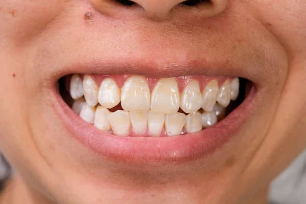 Close Smiling Woman Teeth Revealing White Spots Plaque Tooth Surface — Stock Photo, Image