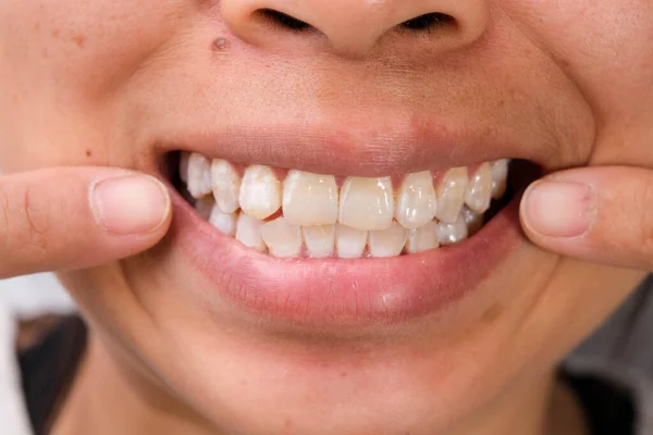 Close Dentes Uma Mulher Sorridente Revelando Manchas Brancas Placa Superfície — Fotografia de Stock