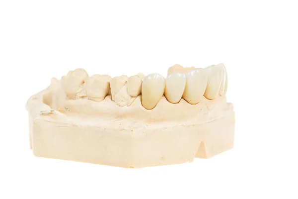 Assistência Médica Dentária Zircônio Cerâmico Versão Final Close Coroa Cerâmica — Fotografia de Stock