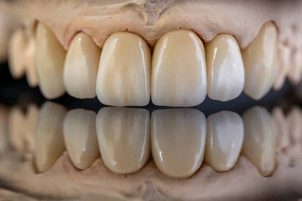 Opieka Dentystyczna Ceramiczny Cyrkon Wersji Końcowej Zamknij Dentystyczne Cyrkonowe Korony — Zdjęcie stockowe