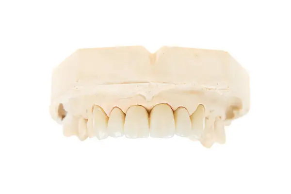 Tandheelkundige Gezondheidszorg Keramische Zirkonium Definitieve Versie Close Tandheelkundige Zirkoon Keramische — Stockfoto