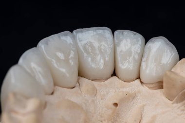 Diş sağlığı hizmetleri. Son versiyonda seramik zirkonyum. Siyah arkaplanda dişçi zirkon seramik taçlarını kapat
