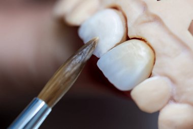 Diş protezi işi. Diş boyama. Teknisyen diş implantının kaplamasına fırça kullanarak seramik malzeme uyguluyor..