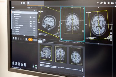 Bilgisayar ekranında MRI beyin taraması. Bir hastanenin radyoloji bölümünde nörolojik teşhis için eksensel, koronal ve sagital görüşleri gösteren gelişmiş tıbbi görüntüleme teknolojisi.