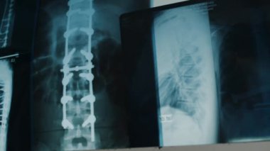 X-ray of whole spine AP and Lateral position in dark background. . High quality FullHD footage