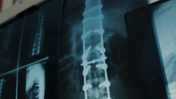 Шийний Хребет Мрт Сканування Або Рентгенівське Відео Тоноване Зосередьтеся Рентгені — стокове відео