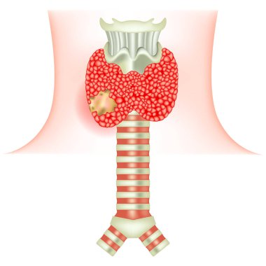 Tiroid kanseri. Bir organı etkileyen bir tümör. Soluk borusunun anatomisi. Vektör illüstrasyonu.