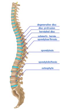 Damaged spine. Infographics of various back diseases. Vector illustration clipart