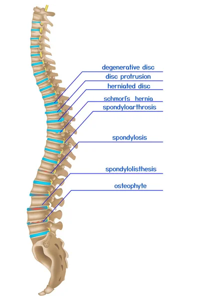 損傷した背骨 様々な背部疾患のインフォグラフィック ベクターイラスト — ストックベクタ
