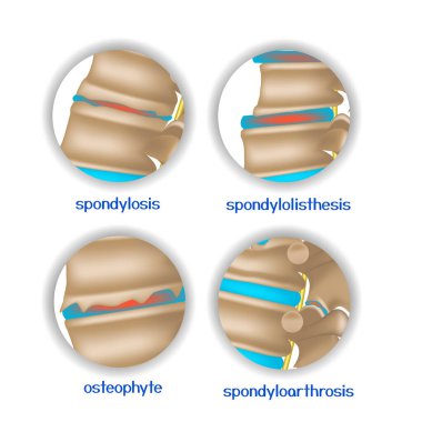 Omurga hastalıkları. Omurgalar arası disklerin ve kemiklerin çeşitli patolojileri. 4 yuvarlak simge. Vektör illüstrasyonu.