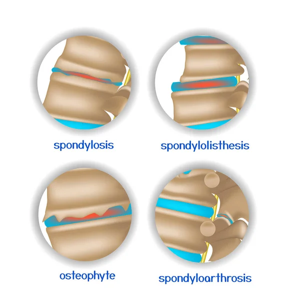 Spine Diseases Various Pathologies Intervertebral Discs Bones Icons Vector Illustration — Stock Vector